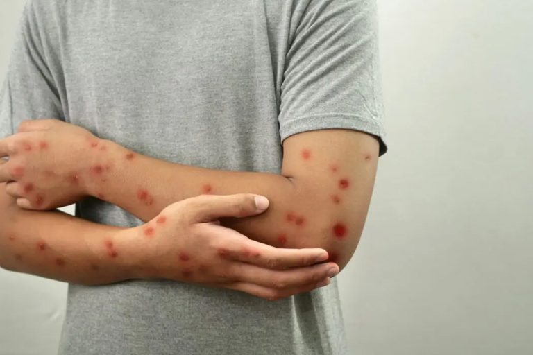 猴痘与水痘 马来西亚哥伦比亚亚洲医院I私立医院