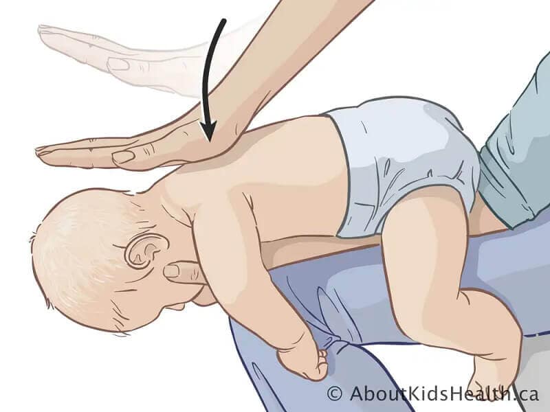 Untuk bayi berumur bawah 1 tahun, tepukkan bahagian belakang bayi untuk mengeluarkan makanan yang tercekik.