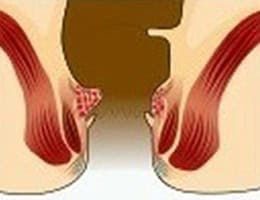 hemorrhoids treatments in malaysia