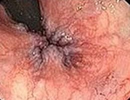 hemorrhoids treatments in malaysia