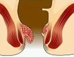 hemorrhoids treatments in malaysia