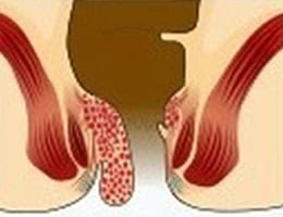 hemorrhoids treatments in malaysia