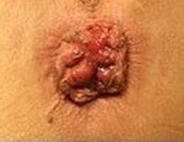 hemorrhoids treatments in malaysia