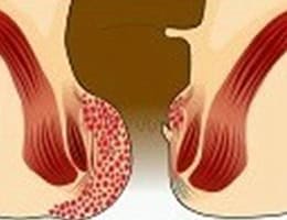 hemorrhoids treatments in malaysia