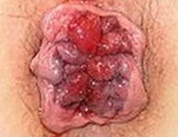 hemorrhoids treatments in malaysia