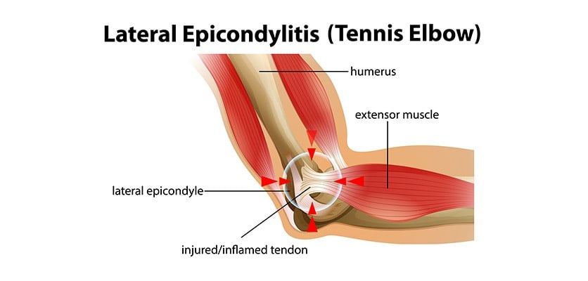 Tennis elbow condition showing injured tendon, causing elbow pain commonly seen in paddle sports players.