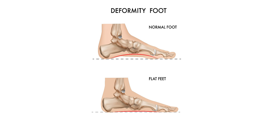 Perbezaan antara lengkungan kaki normal (normal foot) dan kaki rata (flat feet) yang mempengaruhi pemilihan kasut